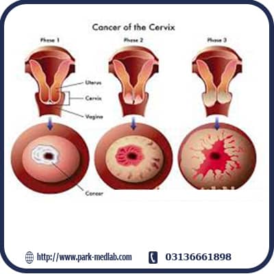 روش پاپ اسمیر استاندارد Thin Prep
